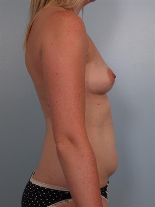 Tummy Tuck Before Photo | Phoenix and Scottsdale, AZ | Scottsdale Center for Plastic Surgery