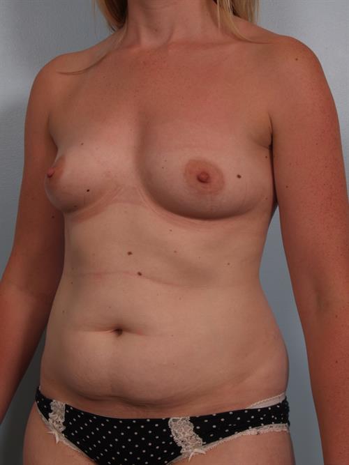 Tummy Tuck Before Photo | Phoenix and Scottsdale, AZ | Scottsdale Center for Plastic Surgery