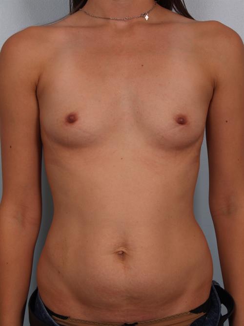 Breast Augmentation Before Photo | Phoenix and Scottsdale, AZ | Scottsdale Center for Plastic Surgery