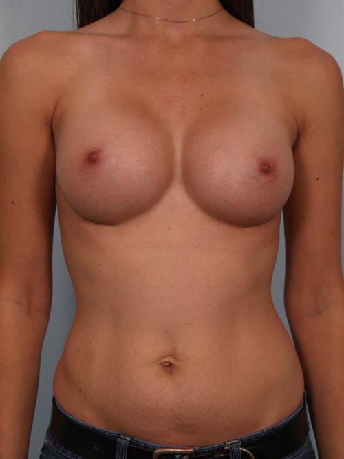 Breast Augmentation After Photo | Phoenix and Scottsdale, AZ | Scottsdale Center for Plastic Surgery