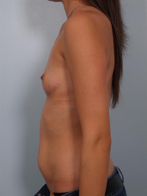 Breast Augmentation Before Photo | Phoenix and Scottsdale, AZ | Scottsdale Center for Plastic Surgery