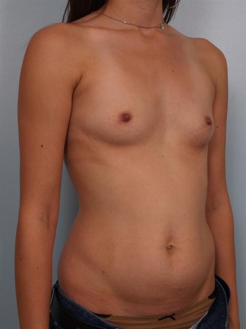 Breast Augmentation Before Photo | Phoenix and Scottsdale, AZ | Scottsdale Center for Plastic Surgery