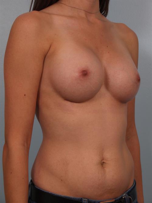 Breast Augmentation After Photo | Phoenix and Scottsdale, AZ | Scottsdale Center for Plastic Surgery