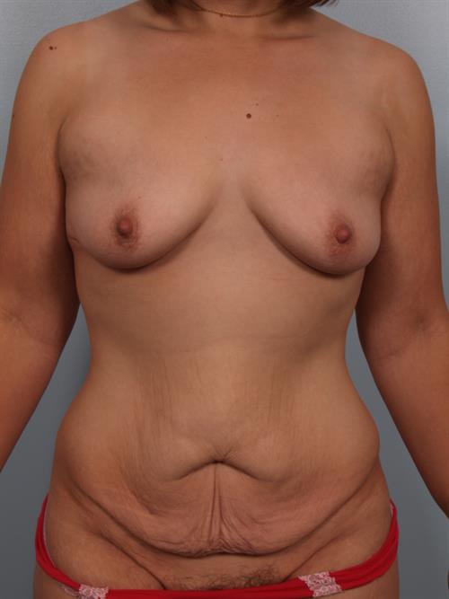Breast Lift (Mastopexy) Before Photo | Phoenix and Scottsdale, AZ | Scottsdale Center for Plastic Surgery