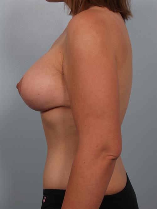 Breast Lift (Mastopexy) After Photo | Phoenix and Scottsdale, AZ | Scottsdale Center for Plastic Surgery
