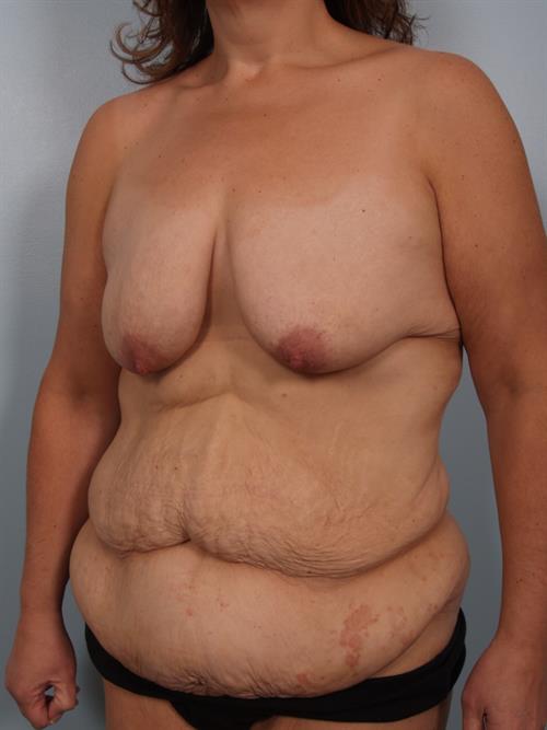 Breast Lift (Mastopexy) Before Photo | Phoenix and Scottsdale, AZ | Scottsdale Center for Plastic Surgery