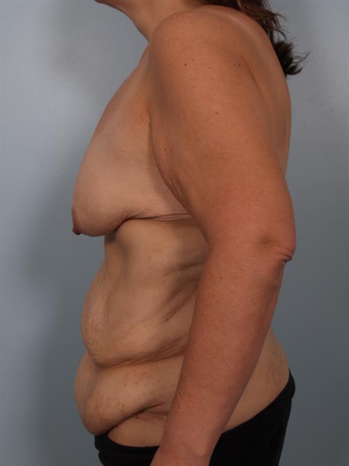 Breast Lift (Mastopexy) Before Photo | Phoenix and Scottsdale, AZ | Scottsdale Center for Plastic Surgery