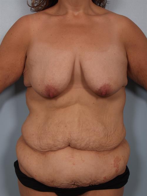 Breast Lift (Mastopexy) Before Photo | Phoenix and Scottsdale, AZ | Scottsdale Center for Plastic Surgery