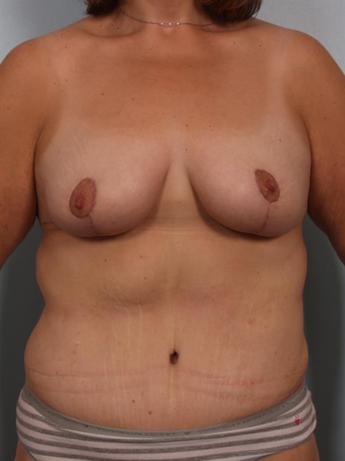 Breast Lift (Mastopexy) After Photo | Phoenix and Scottsdale, AZ | Scottsdale Center for Plastic Surgery