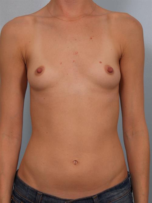 Breast Augmentation Before Photo | Phoenix and Scottsdale, AZ | Scottsdale Center for Plastic Surgery