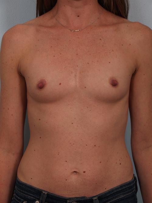 Breast Augmentation Before Photo | Phoenix and Scottsdale, AZ | Scottsdale Center for Plastic Surgery