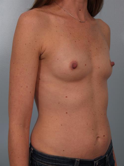 Breast Augmentation Before Photo | Phoenix and Scottsdale, AZ | Scottsdale Center for Plastic Surgery