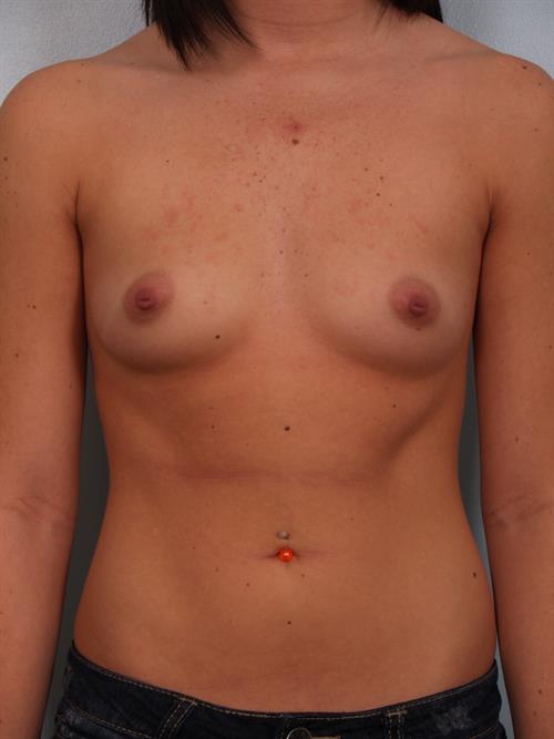 Breast Augmentation Before Photo | Phoenix and Scottsdale, AZ | Scottsdale Center for Plastic Surgery