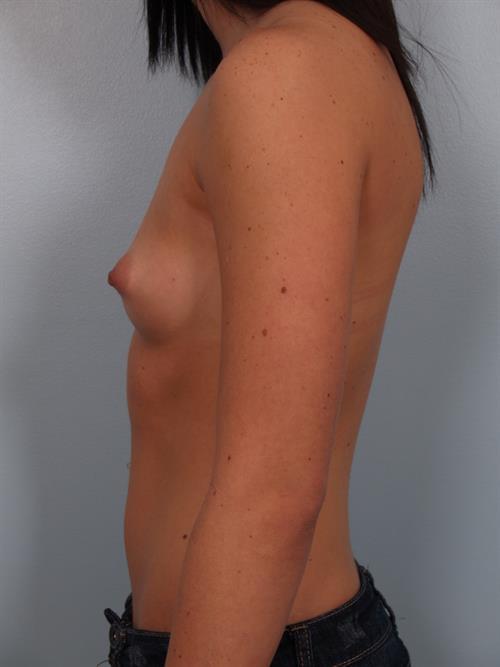 Breast Augmentation Before Photo | Phoenix and Scottsdale, AZ | Scottsdale Center for Plastic Surgery