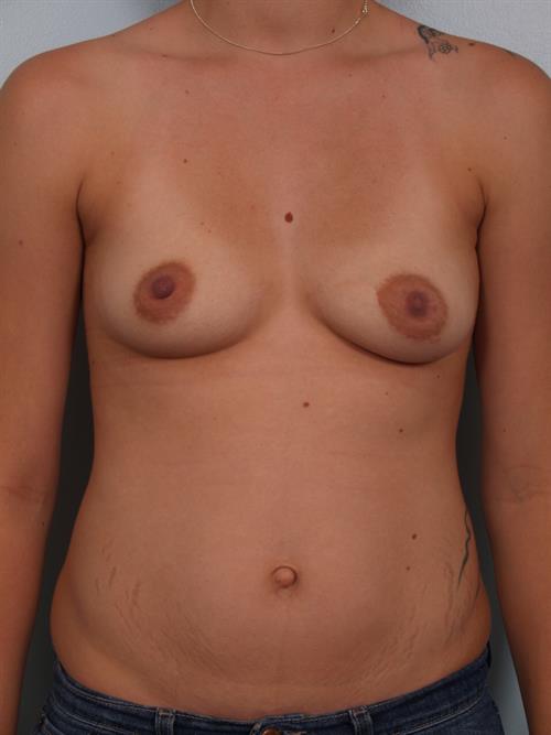 Breast Augmentation Before Photo | Phoenix and Scottsdale, AZ | Scottsdale Center for Plastic Surgery