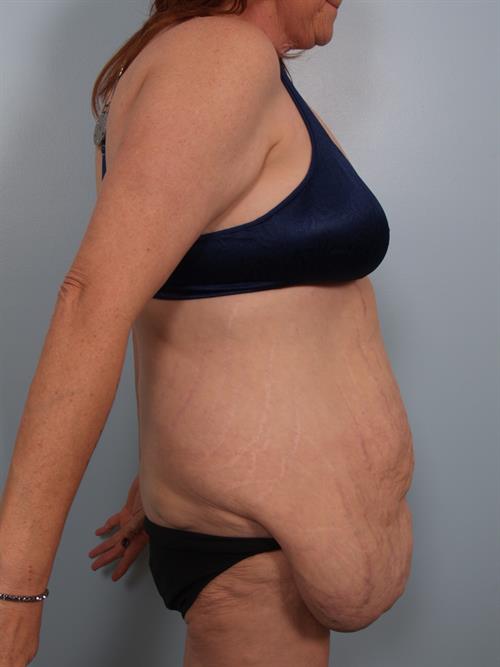 Tummy Tuck Before Photo | Phoenix and Scottsdale, AZ | Scottsdale Center for Plastic Surgery