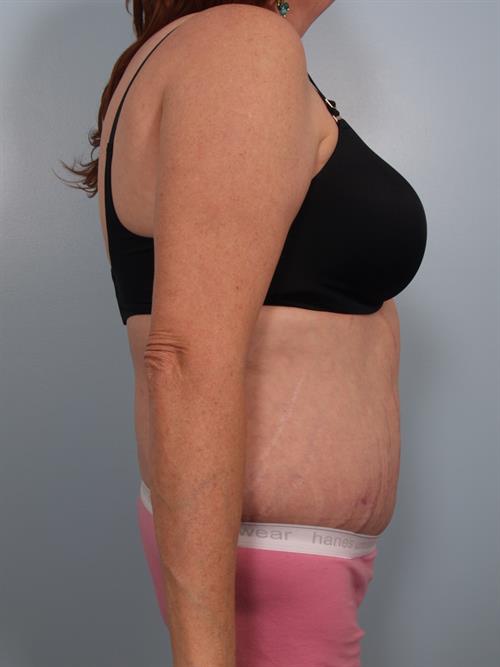 Tummy Tuck After Photo | Phoenix and Scottsdale, AZ | Scottsdale Center for Plastic Surgery