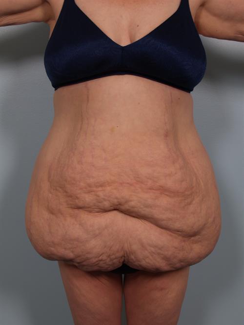 Tummy Tuck Before Photo | Phoenix and Scottsdale, AZ | Scottsdale Center for Plastic Surgery