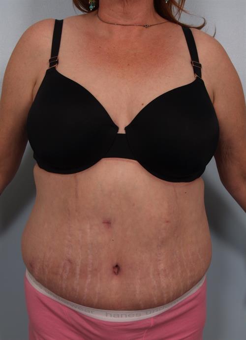 Tummy Tuck After Photo | Phoenix and Scottsdale, AZ | Scottsdale Center for Plastic Surgery
