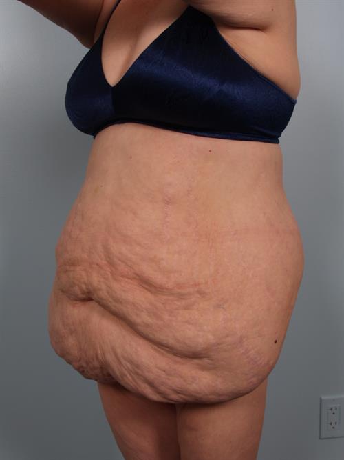 Tummy Tuck Before Photo | Phoenix and Scottsdale, AZ | Scottsdale Center for Plastic Surgery