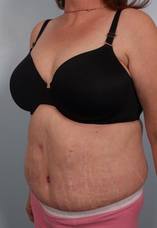 Tummy Tuck After Photo | Phoenix and Scottsdale, AZ | Scottsdale Center for Plastic Surgery