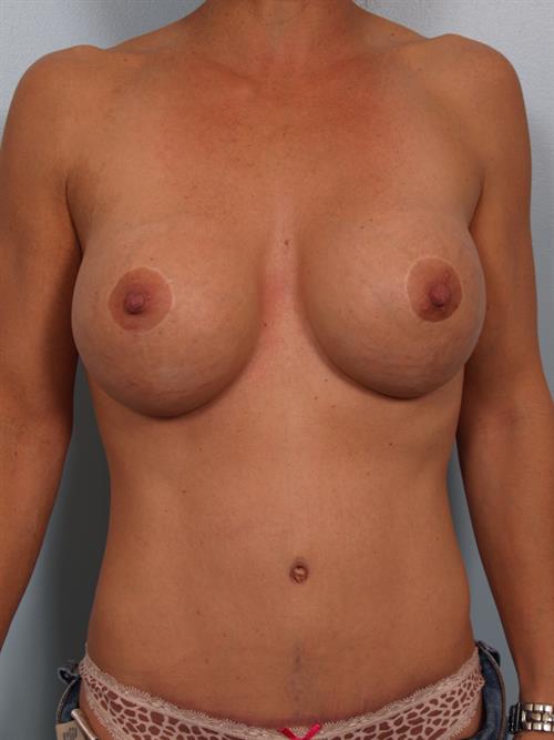 Revision Breast Surgery After Photo | ,  | 