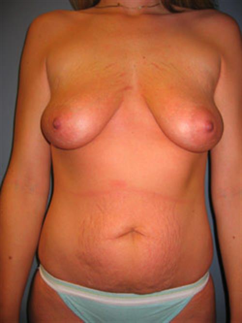 Tummy Tuck Before Photo | Phoenix and Scottsdale, AZ | Scottsdale Center for Plastic Surgery