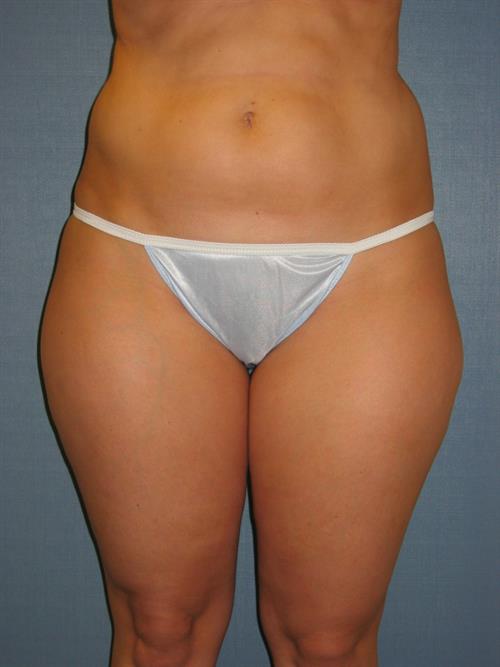 Power Assisted Liposuction Before Photo | Phoenix and Scottsdale, AZ | Scottsdale Center for Plastic Surgery