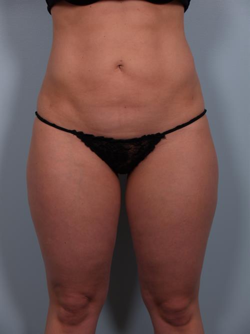 Power Assisted Liposuction After Photo | Phoenix and Scottsdale, AZ | Scottsdale Center for Plastic Surgery