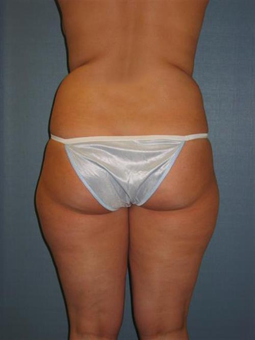 Power Assisted Liposuction Before Photo | Phoenix and Scottsdale, AZ | Scottsdale Center for Plastic Surgery