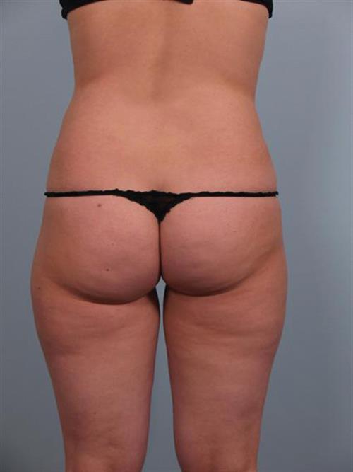 Power Assisted Liposuction After Photo | Phoenix and Scottsdale, AZ | Scottsdale Center for Plastic Surgery