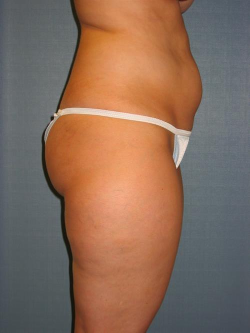 Power Assisted Liposuction Before Photo | Phoenix and Scottsdale, AZ | Scottsdale Center for Plastic Surgery