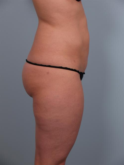 Power Assisted Liposuction After Photo | Phoenix and Scottsdale, AZ | Scottsdale Center for Plastic Surgery