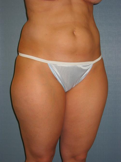 Power Assisted Liposuction Before Photo | Phoenix and Scottsdale, AZ | Scottsdale Center for Plastic Surgery