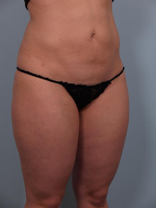 Power Assisted Liposuction After Photo | Phoenix and Scottsdale, AZ | Scottsdale Center for Plastic Surgery