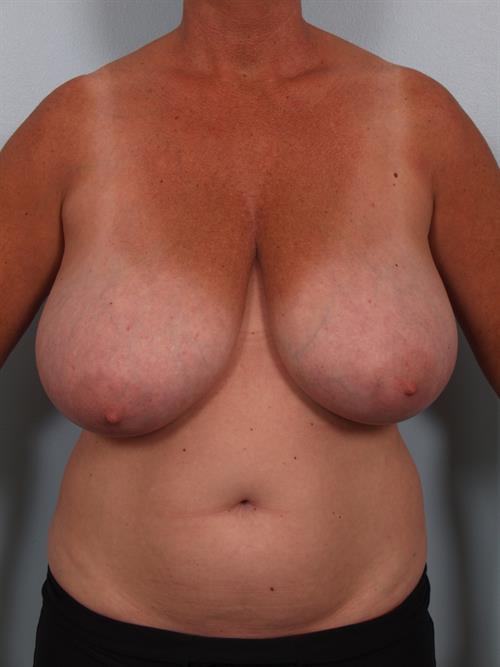 Breast Reduction Before Photo | Phoenix and Scottsdale, AZ | Scottsdale Center for Plastic Surgery