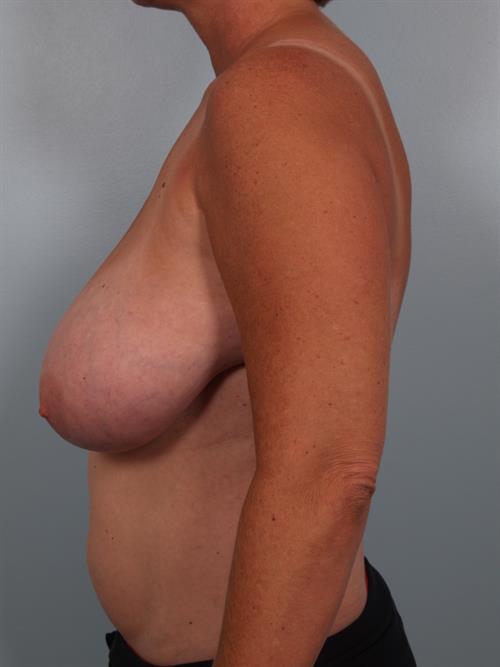 Breast Reduction Before Photo | Phoenix and Scottsdale, AZ | Scottsdale Center for Plastic Surgery