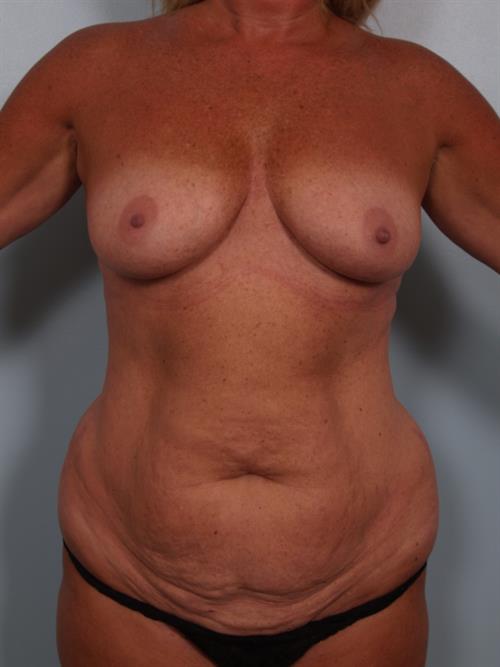 Breast Lift (Mastopexy) Before Photo | Phoenix and Scottsdale, AZ | Scottsdale Center for Plastic Surgery