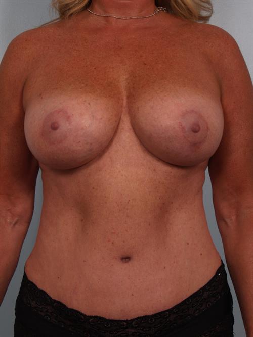 Breast Lift (Mastopexy) After Photo | Phoenix and Scottsdale, AZ | Scottsdale Center for Plastic Surgery