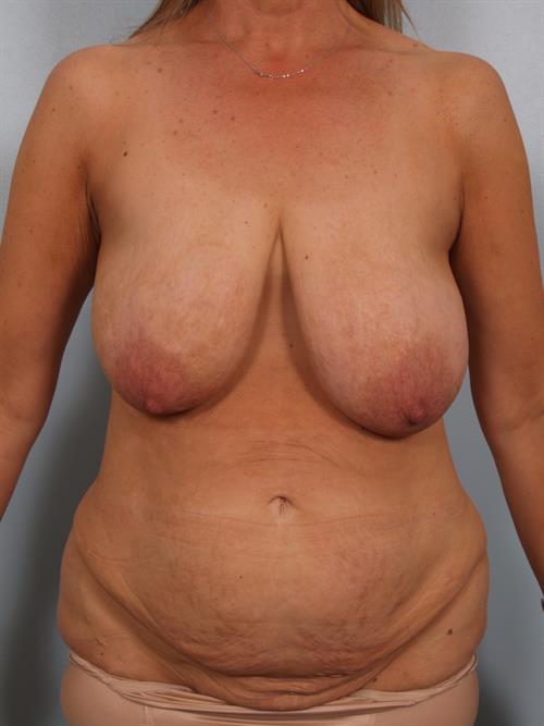 Power Assisted Liposuction Before Photo | ,  | 