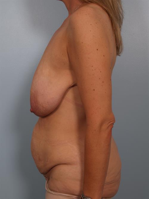 Mommy Makeover Before Photo | , |