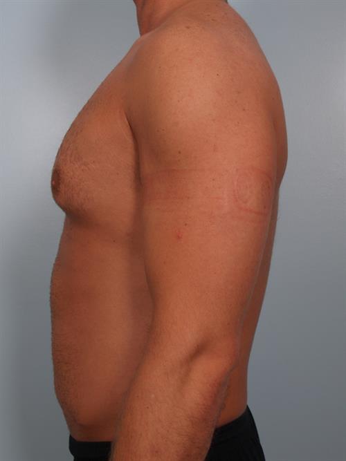 Male Breast/Areola Reduction Before Photo | Phoenix and Scottsdale, AZ | Scottsdale Center for Plastic Surgery