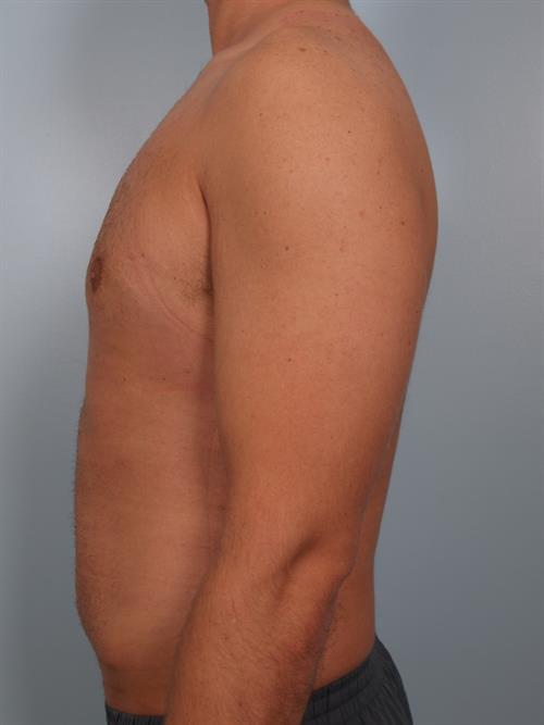 Male Breast/Areola Reduction After Photo | Phoenix and Scottsdale, AZ | Scottsdale Center for Plastic Surgery