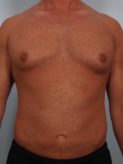 Male Breast/Areola Reduction Before Photo | Phoenix and Scottsdale, AZ | Scottsdale Center for Plastic Surgery