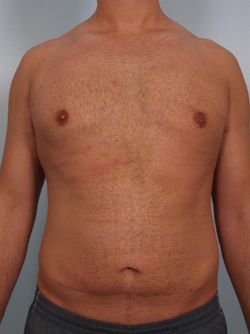 Male Breast/Areola Reduction After Photo | Phoenix and Scottsdale, AZ | Scottsdale Center for Plastic Surgery