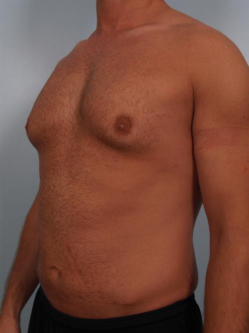Male Breast/Areola Reduction Before Photo | Phoenix and Scottsdale, AZ | Scottsdale Center for Plastic Surgery