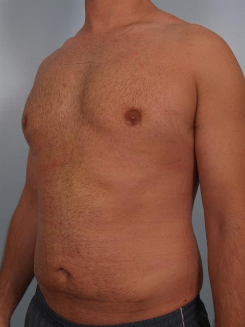 Male Breast/Areola Reduction After Photo | Phoenix and Scottsdale, AZ | Scottsdale Center for Plastic Surgery