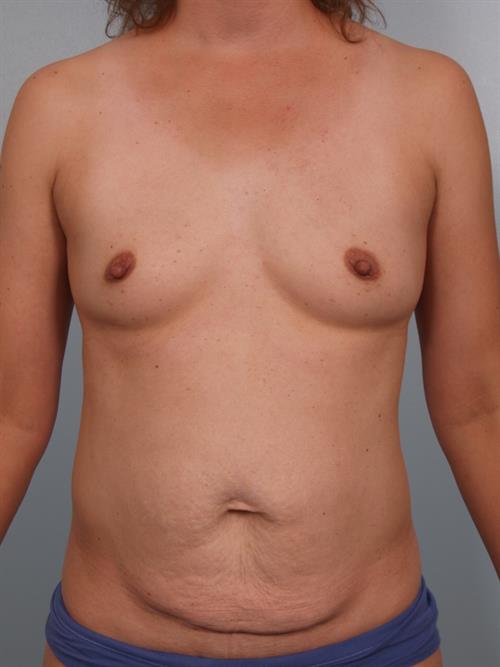 Tummy Tuck Before Photo | Phoenix and Scottsdale, AZ | Scottsdale Center for Plastic Surgery