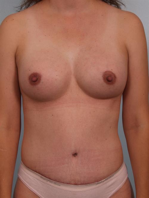 Tummy Tuck After Photo | Phoenix and Scottsdale, AZ | Scottsdale Center for Plastic Surgery