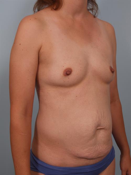 Tummy Tuck Before Photo | Phoenix and Scottsdale, AZ | Scottsdale Center for Plastic Surgery